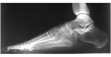 正常足的右足正侧位片,女,54岁,无足部疾患.无跖痛,胼胝及锤状趾.